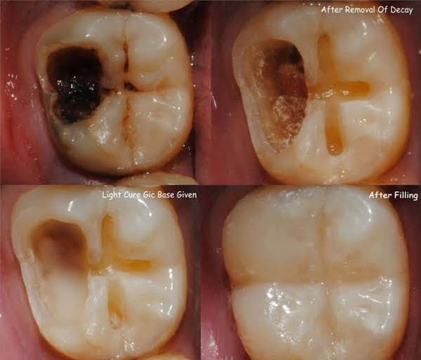 Dental Fillings Vadodara
